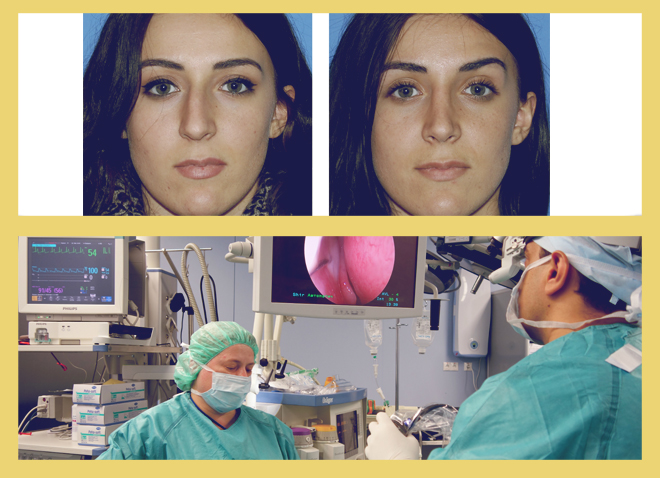 операция по выпрямлению носовой перегородки, до и после