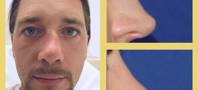 Операция по исправлению перегородки носа, кому она необходима?