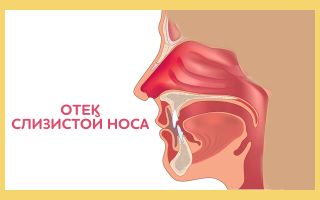 Причины и симптомы отека слизистой носа